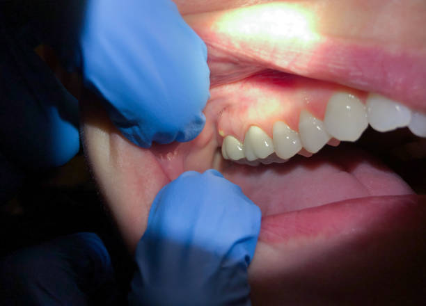 Best Urgent Tooth Repair  in Montegut, LA