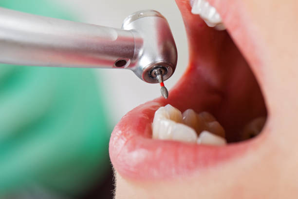 Best Root Canal Emergency Dentist  in Montegut, LA